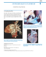 4. Còn ống động mạch và Cửa số phế chú (Patent Ductus Arteriosus -Aortopulmonary Window)_Biên dịch Bs Nguyễn Chí Phồn.pdf