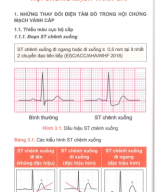 3 điện tâm đồ trong hội chứng vành cấp.pdf