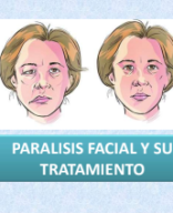 TEMA 57 - PARALISIS FACIAL.pdf