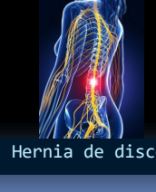 TEMA 61 - HERNIA DISCAL.pdf