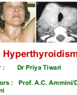 Hyperthyroidism (2010).pptx