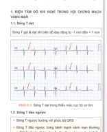 4 điện tâm đồ trong hội chứng vành mạn.pdf